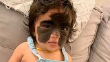 女婴患罕见皮肤病 面部天生有“蝙蝠侠面具”