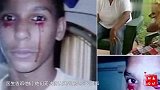 美国15岁少年,每天要流3次血泪,医生说这不是病