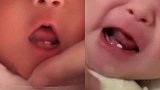 吉林一女婴出生便长两颗牙 医生：属诞生牙 没松动可留