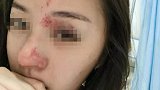 广西女子受邀去朋友店做客 拒绝敬酒遭同桌男子暴打致骨折