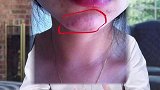 下巴上不痛不痒的白色小颗粒到底是什么？怎么才能去掉呢？皮肤