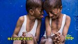印度两兄弟只有8岁和13岁 却老的太快 3岁时牙齿掉光