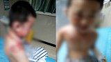 东莞一月嫂端开水烫伤男童脸部红肿起泡 家政：月嫂已下线