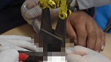 河南一男子下体被钢环卡死3天 医生：再不取下就废了