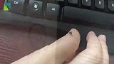 被蚊子咬了又肿又痒，教你一招，不涂药膏，1分钟快速止痒
