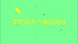 李欣蕊长大前后对比：短短数年判若两人，病好了变得更清秀漂亮了