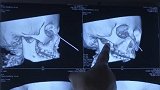 吓人！长沙6岁女童不慎跌倒 铅笔不偏不倚插入右眼眶