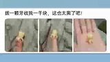 拔智齿，拔出一颗“八爪鱼”