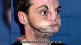 科幻片一般的手术，毁容男子接受全脸移植，重获新生