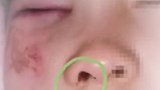 考试填空题漏写数学单位，小学生被老师殴打险致失明！涉事老师：不是有意的……