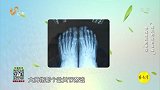 痛风除了痛之外,还会有什么表现?