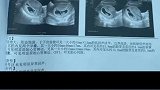 河南平顶山：宝爸宝妈用独特方式，记录双胞胎怀孕过程