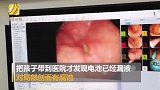 冲动惹祸！19岁女孩赌气吞电池14天未排出 胃被腐蚀