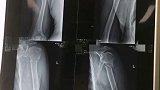 62岁老人，男性，双侧肱骨近端骨折！健身达人，单杠上悬挂卷身360度翻转时意外受傷！唉！锻炼虽好可得注意安全