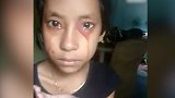罕见！印度8岁女孩患“汗血病” 流出的汗液都是红色