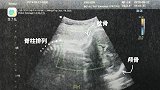 孕期日记vlog28.1——1级B超检查，我宝宝头有点大