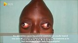 尖脑袋外星人? 乌干达男孩饱受面部畸形症困扰头骨变尖, 眼球外突
