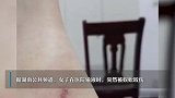 女子过敏去输液又被蜈蚣咬到，医生：输的液正好能解蜈蚣毒