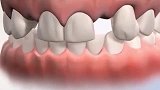 缺牙也可以矫正，矫正牙与种植牙同时进行
