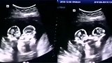 罕见影像！银川一对双胞胎竟在妈妈肚里“打架”