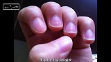 指甲盖为啥有竖纹，其实这是它在向我们求救，大家一定要重视
