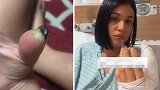 巴西：女子美甲后导致拇指伤口感染，被迫截掉指尖
