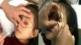 河南一7岁女童眼睛里被同学强塞小纸片 医生取出几十片