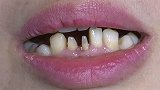 哈尔滨女子诊所治牙“出意外” 结果竟导致痔疮复发