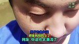 男子钓鱼失误,把鱼钩挂脸上了