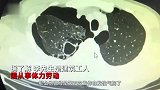 30年老烟民咳嗽胸闷竟是“肺爆炸”，每天抽烟10几根：第4次发作