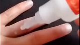 自作聪明用502胶水粘伤口