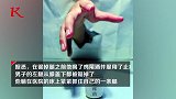 大千世界，无奇不有！男子锯掉自己一条腿 手拿着腿让医生治疗