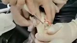牙科医生的实习，看到这一幕，隔着屏幕我的牙都觉得疼！