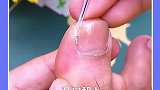 指甲长肉里的朋友，记得看完这个视频