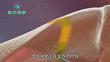 阑尾炎切除全过程，3D动画演示，被拔除的瞬间简直太刺激了！