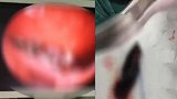 广东一9岁女孩泳池游泳后常流鼻血 医生手术取出一蚂蝗