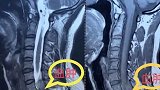 脖子酸痛女白领反复扭了扭，9小时后竟瘫痪了！这两类人千万别做