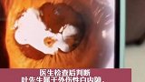 广东深圳：男子视力变差取出24年前鞭炮炸入石子