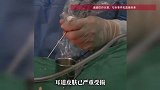 男子右耳钻心剧痛、流血，竟从耳内取出70余条蠕动的蛆虫，医生回应