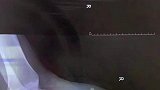 男子踢球失误踢到狗嘴，狗牙断进男子脚面