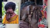旅游--印度21岁女孩患怪病：五官融化至胸口_clip