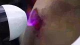 大气低温等离子体伤口愈合治疗，这又是什么新科技