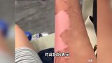 小孩玩氢气球爆炸妈妈跑开遭网暴，妈妈：自己大面积烧伤