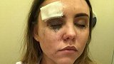 英格兰女球迷欢庆遭毁容 额头裂开眼睛差点被砸瞎