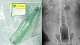 东莞一男子将18厘米长花露水瓶塞进体内 原因让人哭笑不得