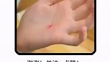 小技巧：小伤口处理小技能上热门伤口小技