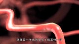 老外发明“血栓清除仪”，两分钟清理的干干净净！获30多项专利