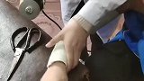 来医院拆石膏，当时我害怕极了，真怕她手突然抖了一下！