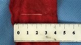 一根鱼刺竟让他花费50万 医生提醒：这种情况别吃鱼