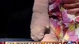 美国小女孩玩滑梯被烫伤 温度高达73度-5月31日